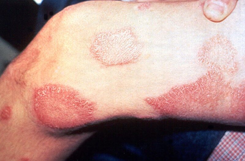 File:Leprosy thigh demarcated cutaneous lesions.jpg
