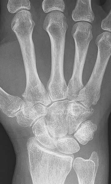 File:Rheumatoid arthritis with unaffected carpal bones 2009.jpg