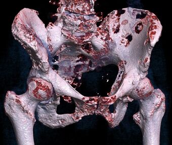 3D rendered CT of hip bone metastases.jpg