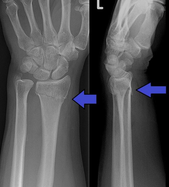 File:Collesfracture.jpg