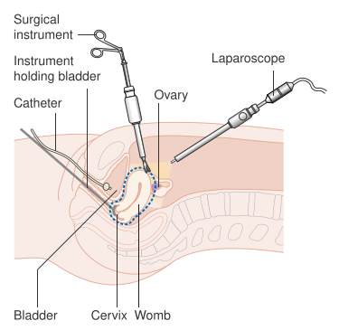 File:Diagram showing keyhole hysterectomy CRUK 164.svg