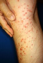 Human leg three days after brief contact with fire ant colony