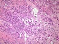 Histopathology of adenosquamous carcinoma of the pancreas.jpg
