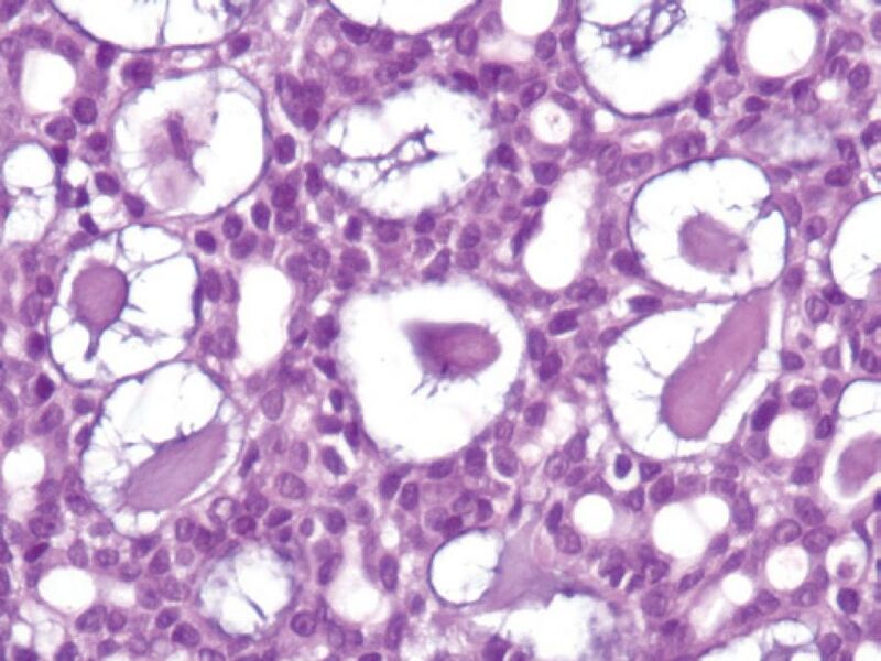 File:Micrograph of adenoid cystic carcinoma.jpg
