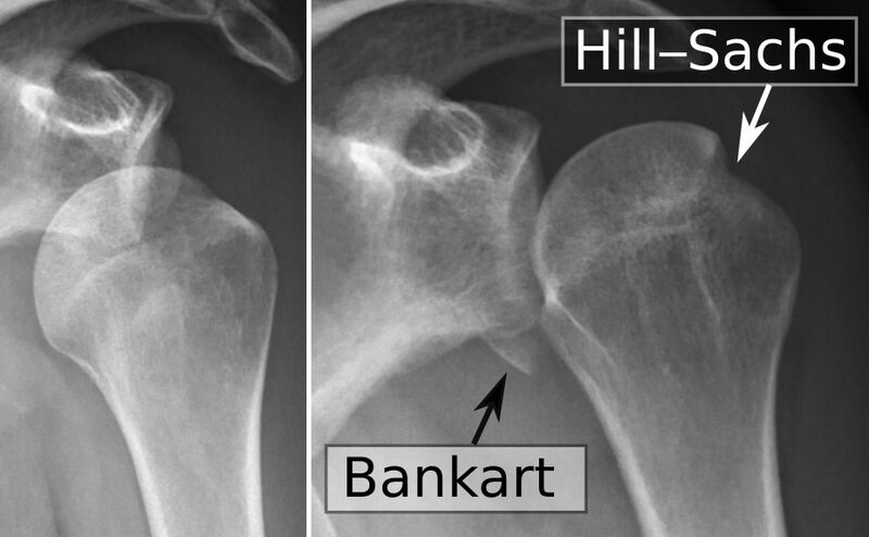 File:Shoulder dislocation with Bankart and Hill-Sachs lesion, before and after reduction.jpg