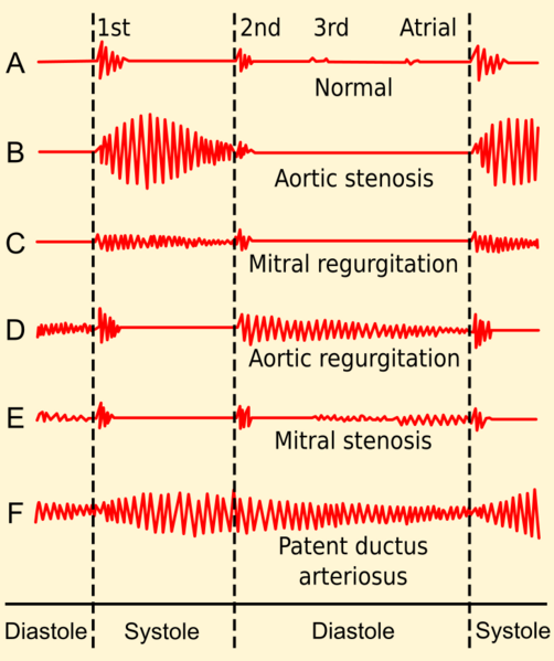 File:Phonocardiograms from normal and abnormal heart sounds.svg