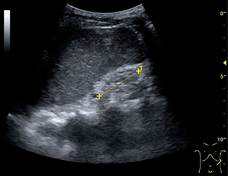 File:Ultrasonography of end-stage chronic kidney disease.jpg