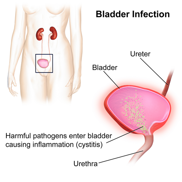 File:Bladder Infection.png