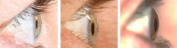 Different anterior chamber depths as seen from the lateral perpendicular view.png