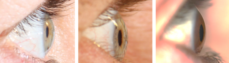 File:Different anterior chamber depths as seen from the lateral perpendicular view.png