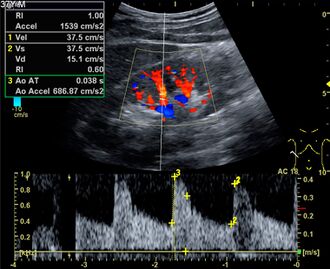 Doppler ultrasound of systolic velocity (Vs), diastolic velocity (Vd), acceleration time (AoAT), systolic acceleration (Ao Accel) and resistive index (RI) of normal kidney.jpg
