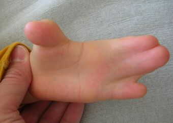 Hand in Apert syndrome (1).JPG