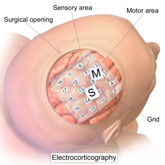 Intracranial electrode grid for electrocorticography.png
