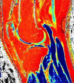 T1 Map of cartilage.jpg