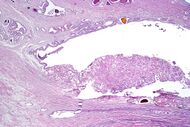 Urothelial carcinoma in the prostatic urethra, low mag.jpg