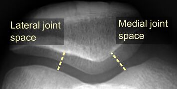 Lateral and medial joint space of patella.jpg