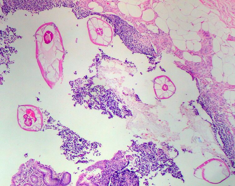 File:Pinworms in the Appendix (1).jpg