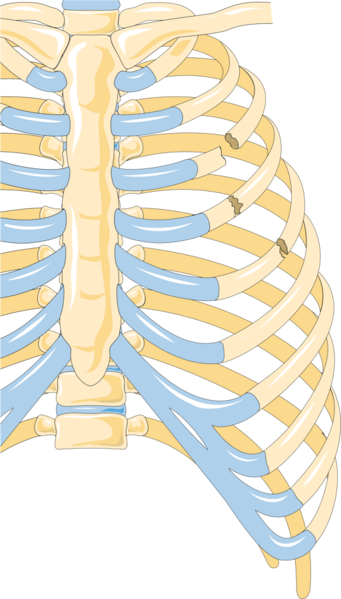File:Rib fractures 2 -- Smart-Servier.png