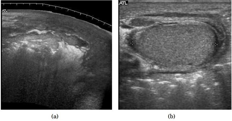 File:Scrotal ultrasonography of Fournier gangrene.jpg