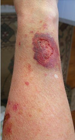Steroid induced atrophy arm.png