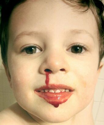 Young child with nosebleed, smiling cropped.jpg