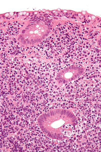 File:Gastrointestinal lymphoepithelial lesion - very high mag.jpg