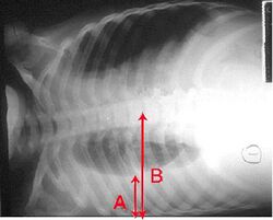 An X-ray showing a chest lying horizontally. The lower black area, which is the right lung, is smaller with a whiter area below it of a pulmonary effusion. Red arrows indicate size.