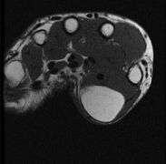T1 MRI of the same lipoma: High intensity signal mass with regions of ill-defined margins.