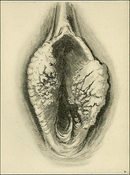 File:The Principles and practice of gynecology - for students and practitioners (1904) (14581300578).jpg