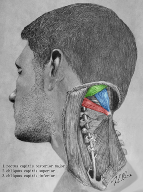 Suboccipital triangle dissection - Suboccipital triangle.png