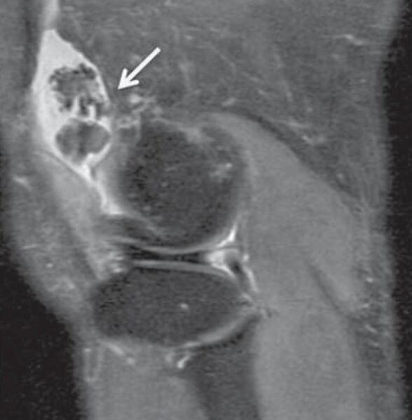 File:PD MRI of synovial chondromatosis of the knee.jpg