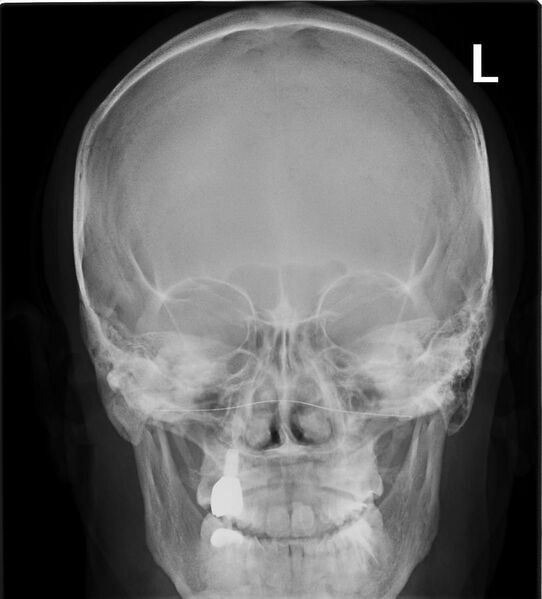 File:Paranasal sinuses radiograph occipitofrontal.jpg