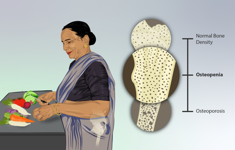 File:Depiction of a woman suffering from Osteopenia.png