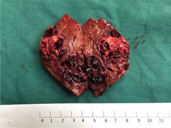 Gross specimen of liver angiosarcoma.jpg