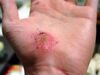 Hand Abrasion - 2 days 22 hours 12 minutes after injury.JPG