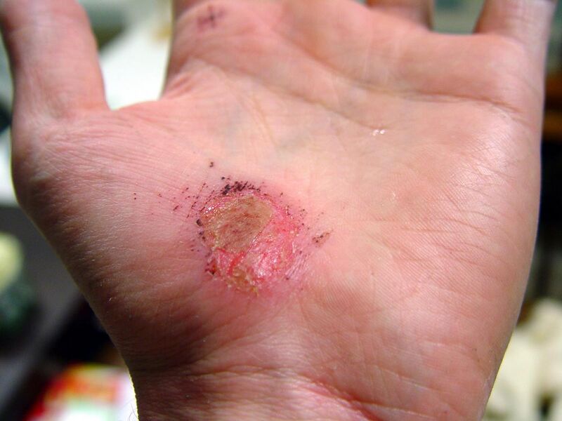 File:Hand Abrasion - 2 days 22 hours 12 minutes after injury.JPG