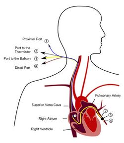 Diagram of Pulmonary artery catheter (PAC)