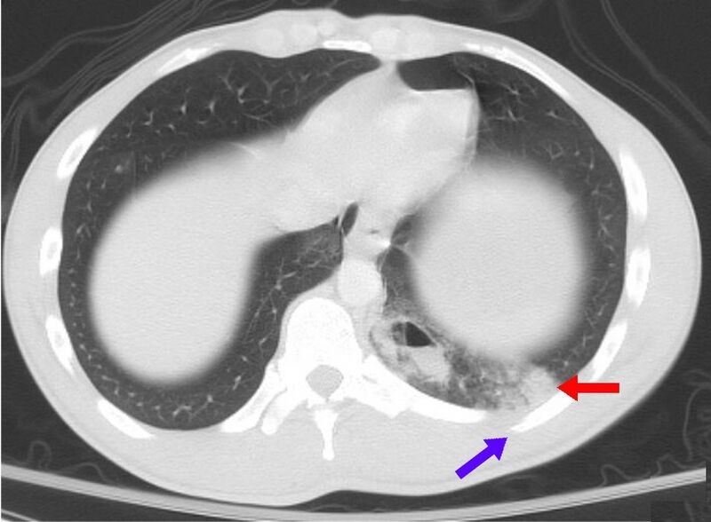 File:Pulmonary contusion CT arrow.jpg