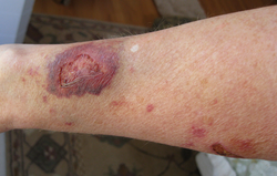 Results of topical steroid damage on skin of a 47 year old female.png