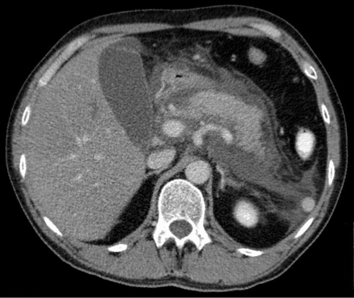 File:Akute exsudative Pankreatitis - CT axial.jpg