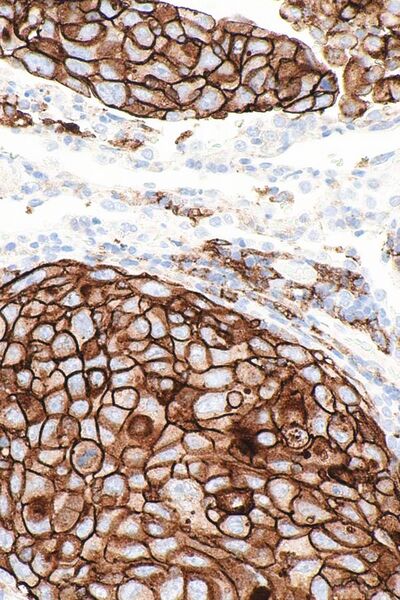 File:PD-L1 positive lung adenocarcinoma -- high mag.jpg