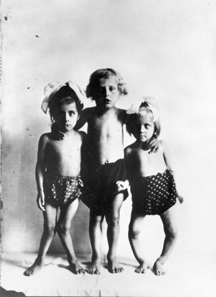 File:Photograph; three children with rickets Wellcome L0014375.jpg