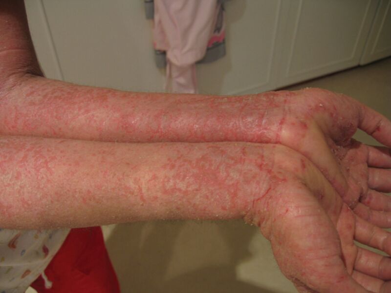 File:520 Eczema.jpg