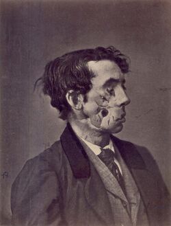 Civil War facial wound.jpg
