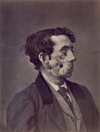 Civil War facial wound.jpg