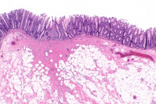 Colorectal polypectomy scar -- very low mag.jpg