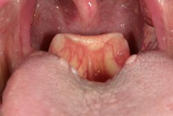 High rising epiglottis.JPG