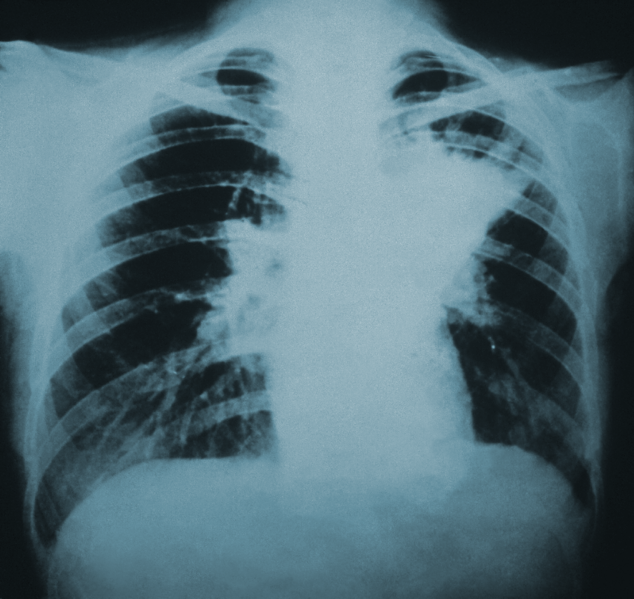 File:Blastomycosis lung infiltration.png