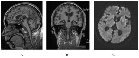 A person with inherited prion disease has cerebellar atrophy. This is typical for GSS.