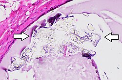 Histopathology of a breast cyst with calcium oxalate crystals, annotated.jpg